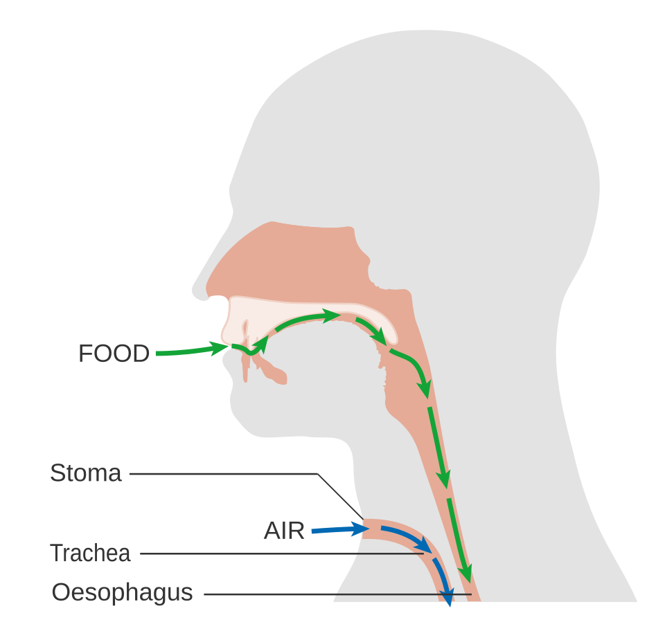Diagram of a laryngectomy: air passes directly in and out of the neck stoma to the trachea, while the mouth and nose connect only to the oesophagus - there is no connection between the upper airway and the lungs.