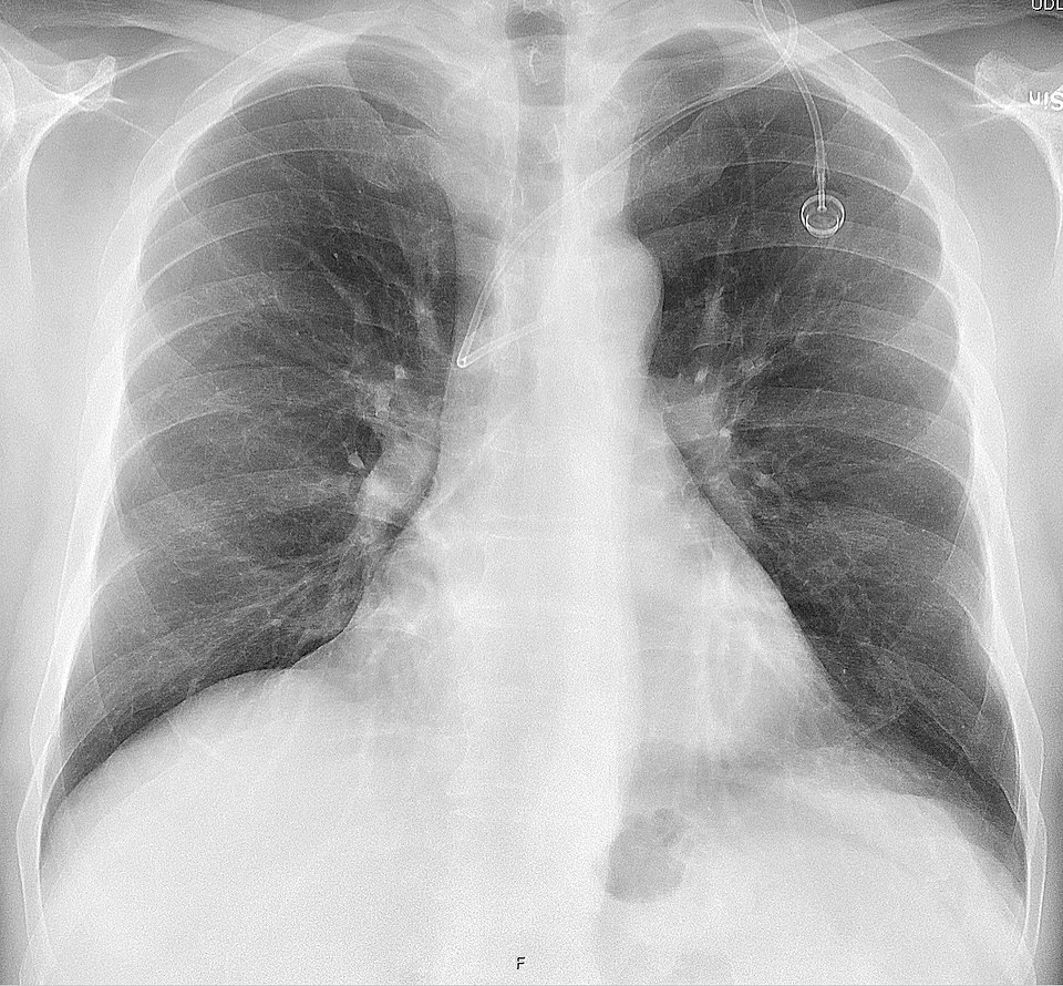 Chest X-ray showing an implanted port: a ring-shaped reservoir in the upper chest wall with its catheter running centrally (in this film the catheter tip lies in the azygos vein, a malposition).