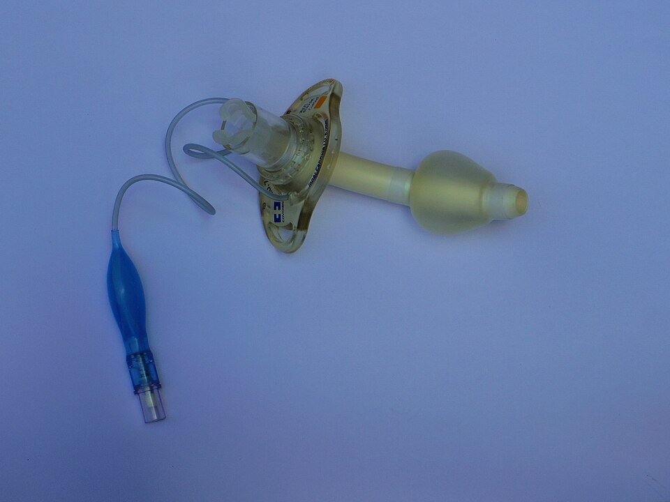 A cuffed tracheostomy tube with its inflated pilot balloon and inner connector.
