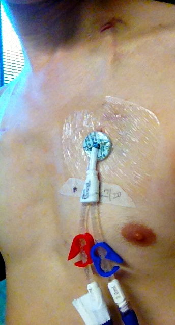 A dual-lumen tunnelled central line exiting the chest wall beneath a transparent dressing, with two clamped coloured lumens.